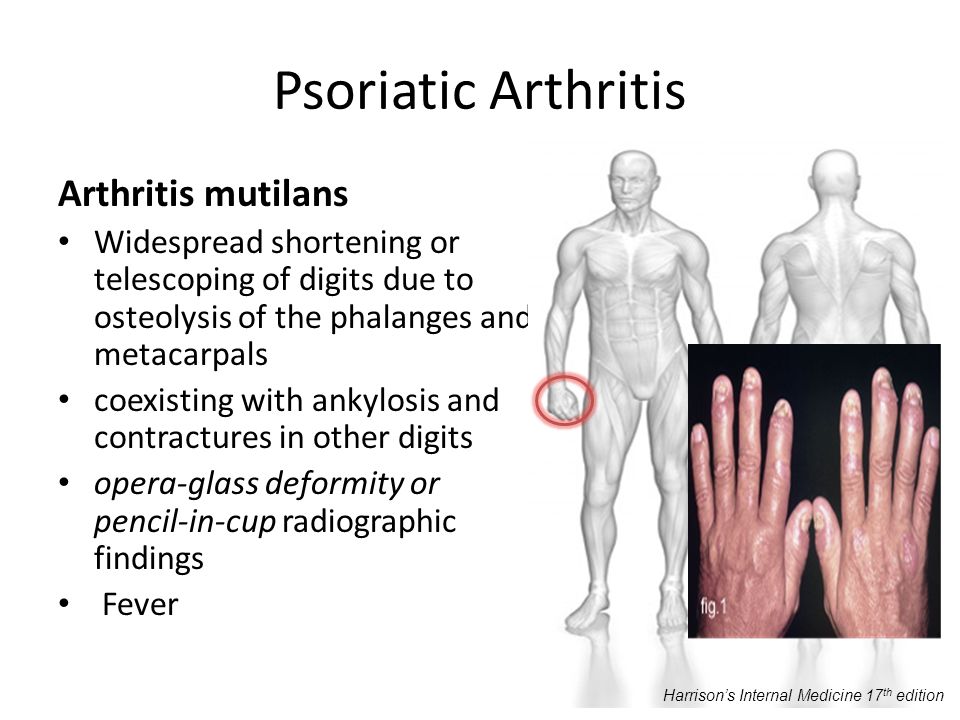 Brote artritis psoriásica